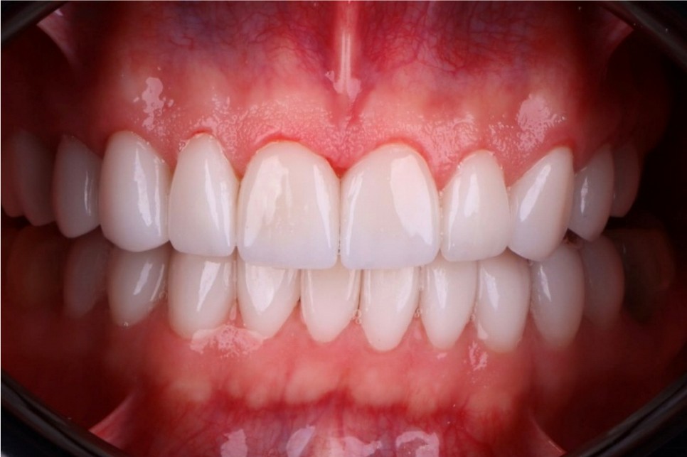 Diseño de Sonrisa