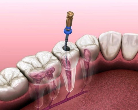Endodoncia