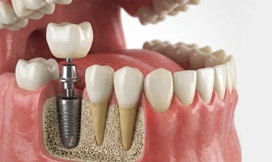 Periodoncia